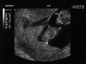 Eleven Week Scan 1