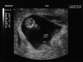 Eleven Week Scan 2