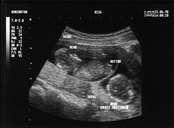 Thirteen Week Scan 3