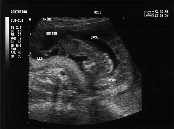 Thirteen Week Scan 2