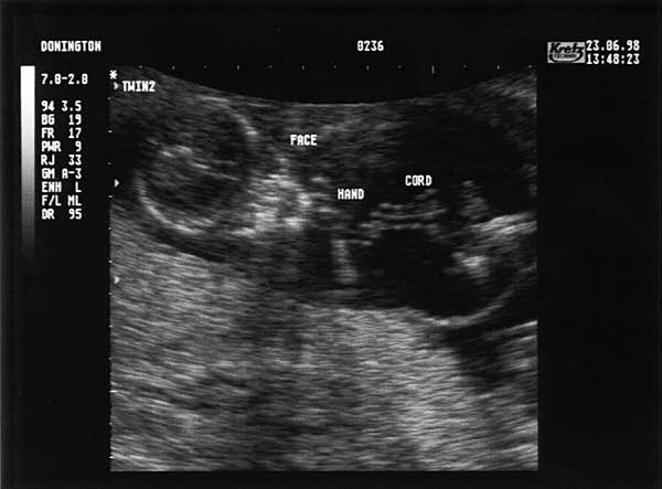 Thirteen Week Scan 1