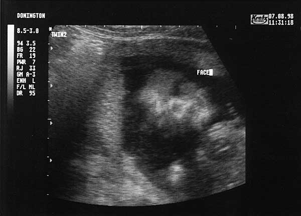 Nineteen Week Scan 3