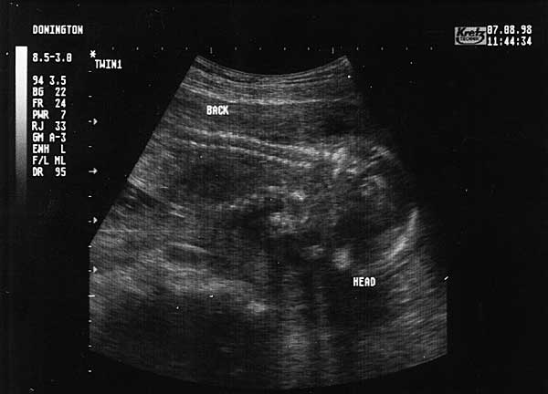 Nineteen Week Scan 2