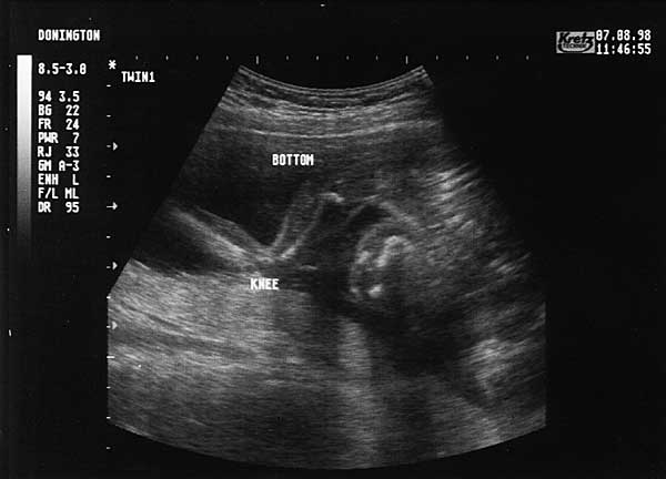 Nineteen Week Scan 1