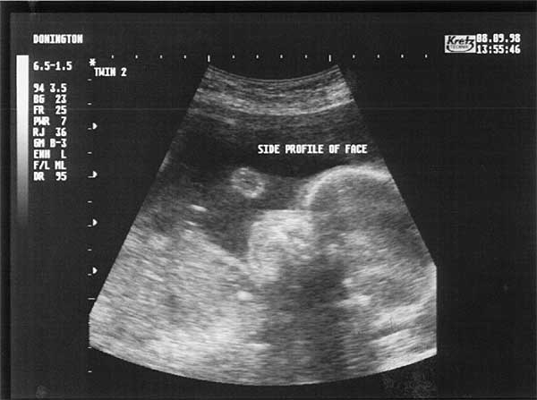 Twenty Four Week Scan 3