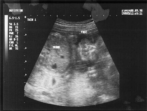 Twenty Four Week Scan 2