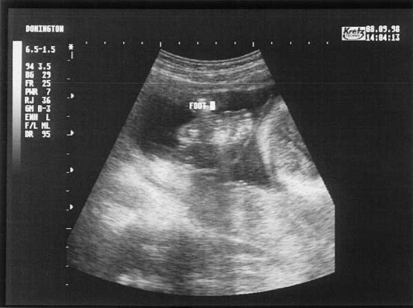 Twenty Four Week Scan 1