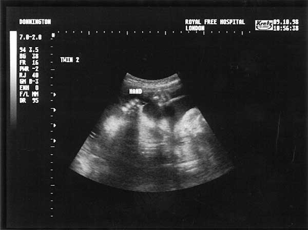 Twenty Eight Week Scan 3