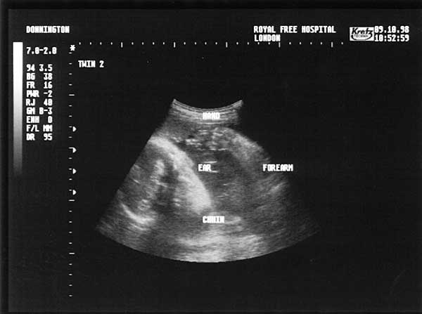 Twenty Eight Week Scan 2