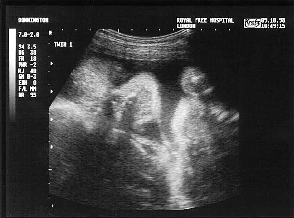 Twenty Eight Week Scan 1